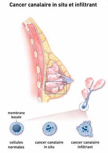 Surcharge pondérale et cancer du sein - RNPC