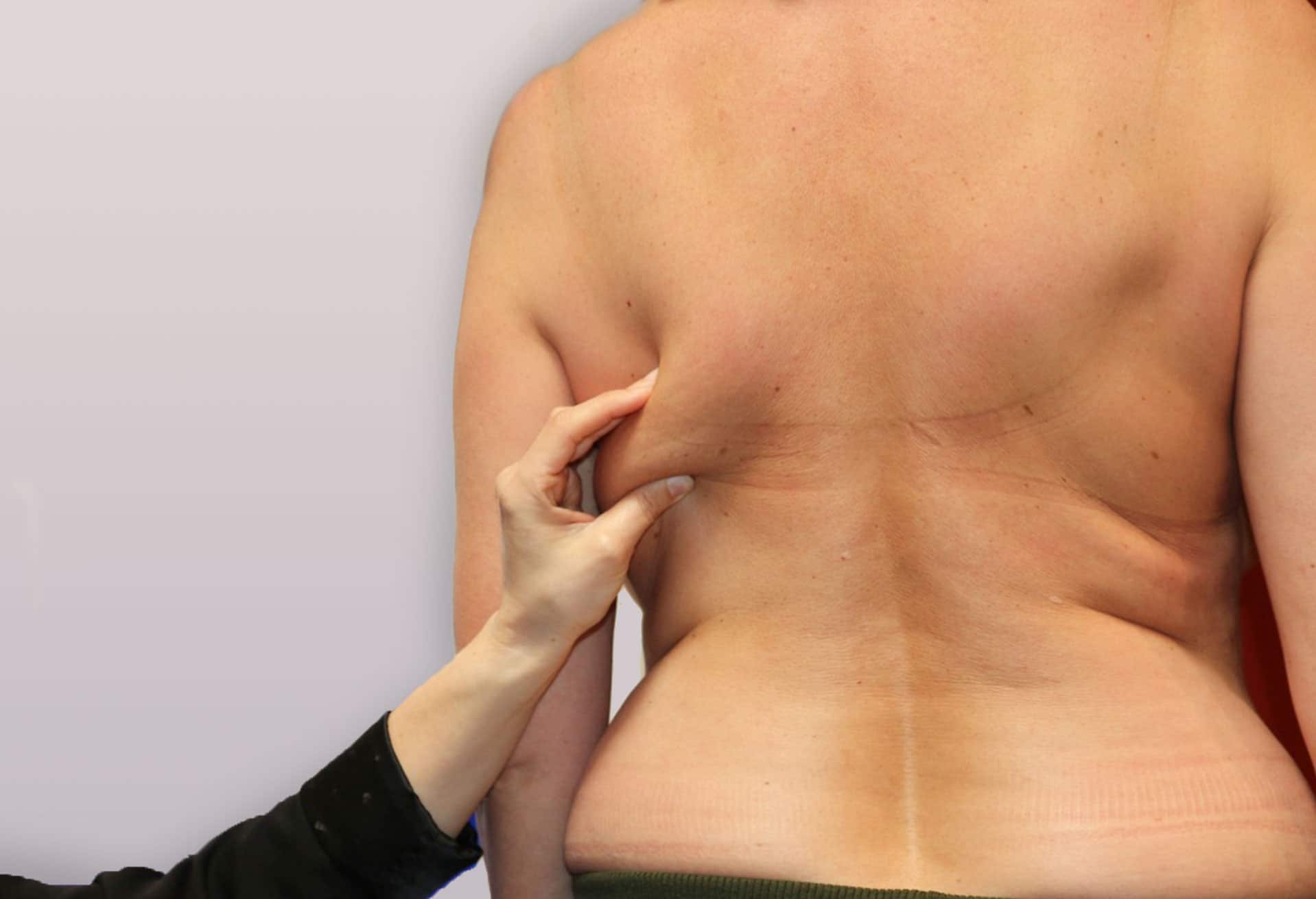 Reconstruction mammaire par lambeau de grand dorsal | Institut du Sein Paris