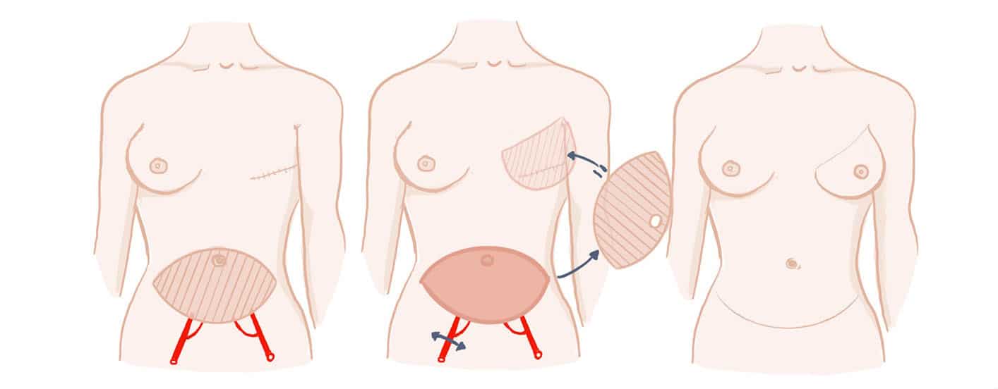 Donor site aesthetics and morbidity after DIEP flap breast reconstruction—A  retrospective multicenter study - Grünherz - 2020 - The Breast Journal -  Wiley Online Library
