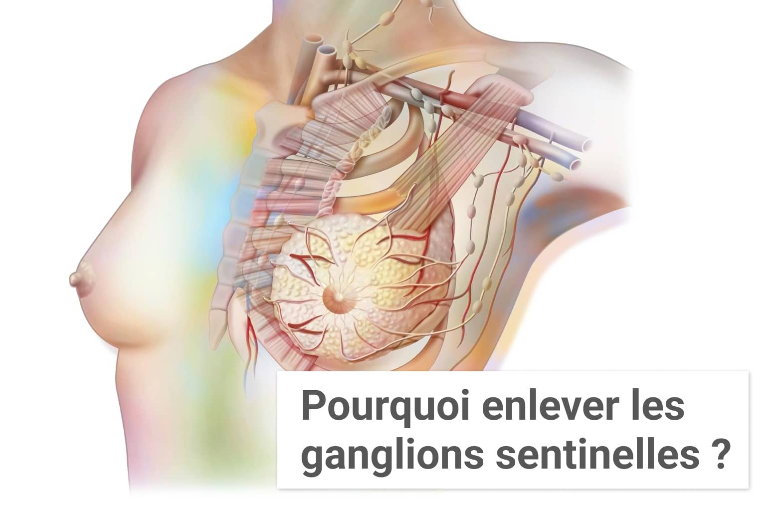 Pourquoi enlever les ganglions sentinelles ? | Institut du Sein | Paris